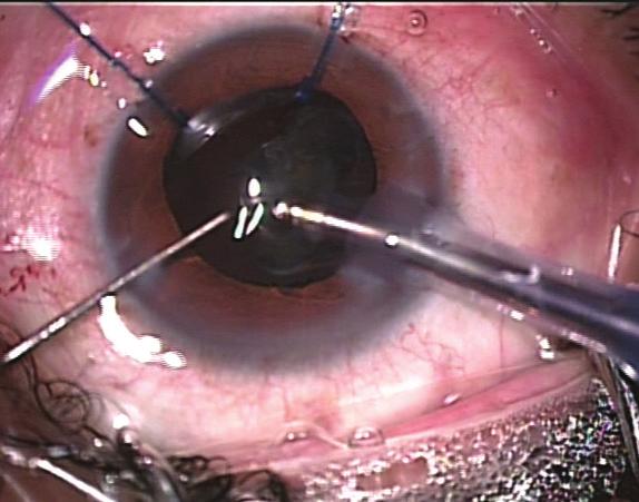 IOL preparation and fixation. Lens power is calculated before surgery using the IOLMaster 500 (Carl Zeiss Meditec) and rechecked with immersion biometry.