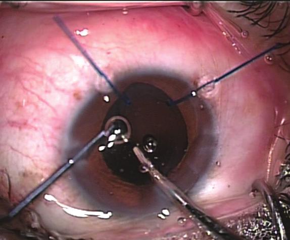The A-constant is the same as would normally be required for in-the-bag implantation for this lens, in this case 118.0. The free end of a 10-0 polypropylene suture on a 1-in Figure 8.