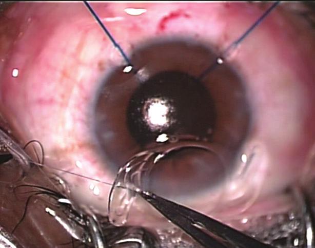 A CATARACT SURGERY Figure 9. The free end of the polypropylene 10-0 suture is tied to the midpoint of the leading haptic. Figure 10. The needle is passed down the barrel of the injector (A).