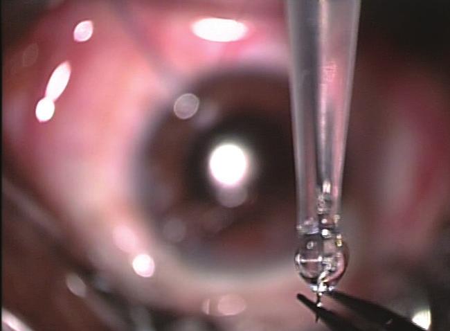 Otherwise, the bag will be pushed back and the hooks will not engage the margin. Pearl No. 2: If the lens is very subluxed and the capsular bag is poor, start the capsulorrhexis with a sharp needle.