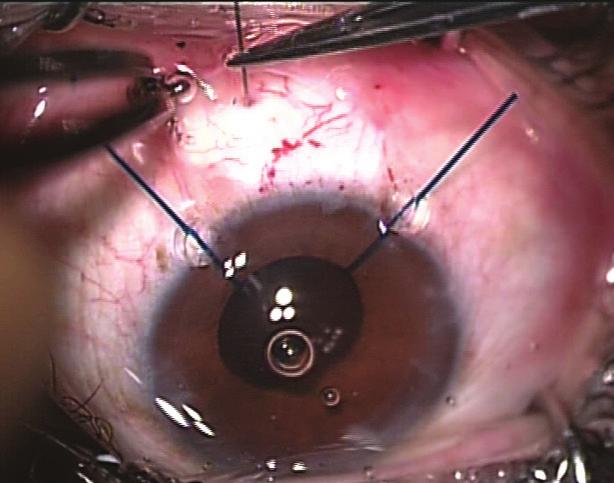 Figure 12. The needle passes through the pars plana and out through the sclera. Figure 13. The IOL is injected into the capsular bag. A Figure 15.