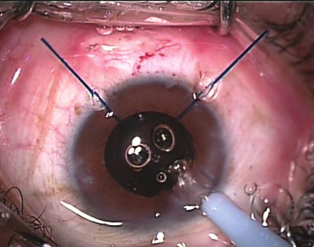 Peyman GA, Raichand M, Goldberg MF, Ritacca D. Management of subluxated and dislocated lenses with the vitrophage. r J Ophthalmol. 1979;63:771-778. 3. Tsai Y-Y, Tseng S-H.