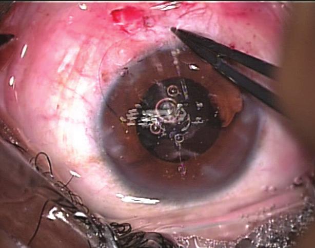 Endocapsular ring approach to subluxed cataractous lens. J Cataract Refract Surg. 1995;21:245-249. 5. Novak J. Flexible iris hooks for phacoemulsification.