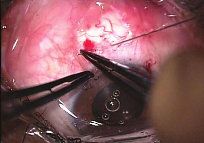 Modified cow-hitch suture fixation of transscleral sutured posterior chamber intraocular lenses: Long-term safety and efficacy. J Cataract Refract Surg. 2008;34:452-458.
