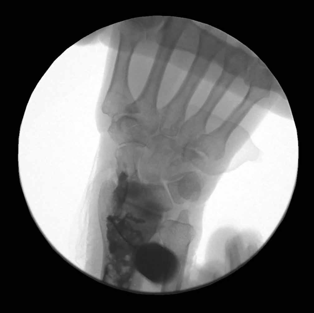 Lourie s practice between 2004 and 2009 had characteristic findings, including a nondisplaced distal radius fracture, localized swelling over the third dorsal compartment, and pain with resisted