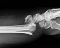 Distal Radius Fractures- Volar Plating for All Frontiers