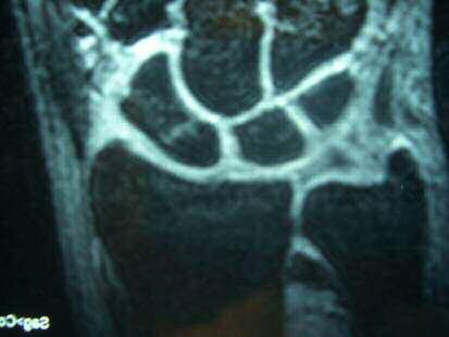 MRI Show fracture within a few hours Show ligament
