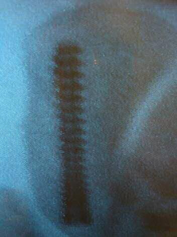 Surgery Not without risks Screw in poor position Screw too long Screw too short