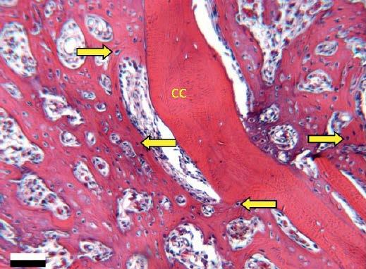 Figure 9: Cancellous + BMA demonstrating the presence of bone marrow and new bone formation