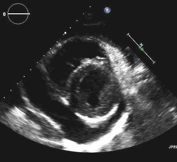 Pericardial effusion on Echo Treated with Ibuprofen 2400