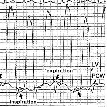 LV/RV Enddiastolic pressure Pulmonary artery systolic