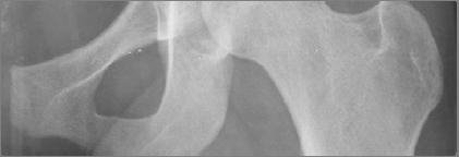 can indicate structural instability Femoral head coverage