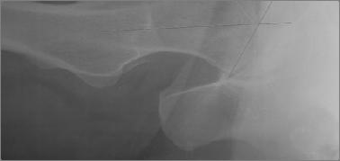 causes outside-in abrasion of the acetabular articular cartilage and damage to the adjacent labrum Deficient
