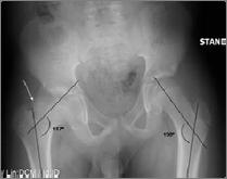 Normal is 125 to 135 <115 highly associated with CAM FAI Center of contralateral femoral head The varus position