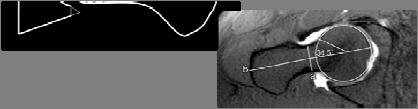 Cam-type Femoroacetabular Impingement Offset of femoral head / neck junction Etiologies: SCFE Legg Calve Perthes disease Posttraumatic