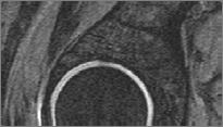 Pincer contrecoup cartilage loss Pincer type Femoroacetabular Impingement Chonrdal loss in posteroinferior acetabulum seen in