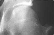 Prevalence in Hips with Femoroacetabular Impingement Hypothesis: Changes at the anterior femoral neck junction are not incidental