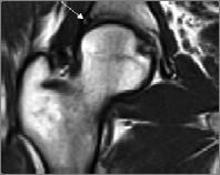 Fibrocystic Changes at Anterosuperior Femoral Neck: Prevalence in Hips with Femoroacetabular Impingement Dynamic MR imaging with hip