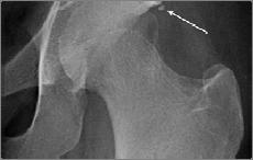 anterosuperior femoral neck and acetabular rim Secondary signs Ossification of the labrum Ossification of the acetabular rim leads to