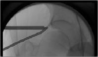 arthroscopy with or without arthrotomy (but without dislocation of the femoral head) Surgical dislocation of the hip and for complete