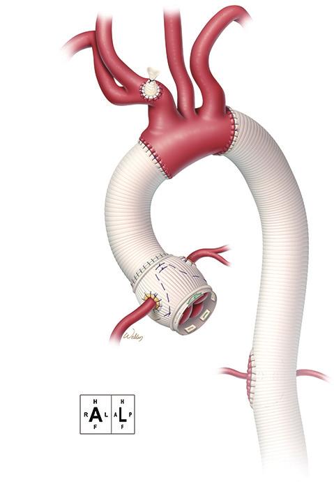 The aneurysm was opened at the sinotubular junction, the Figure 1 Illustration of annuloaortic ectasia, the distinctive aortic root dilatation that is commonly present in patients with Marfan