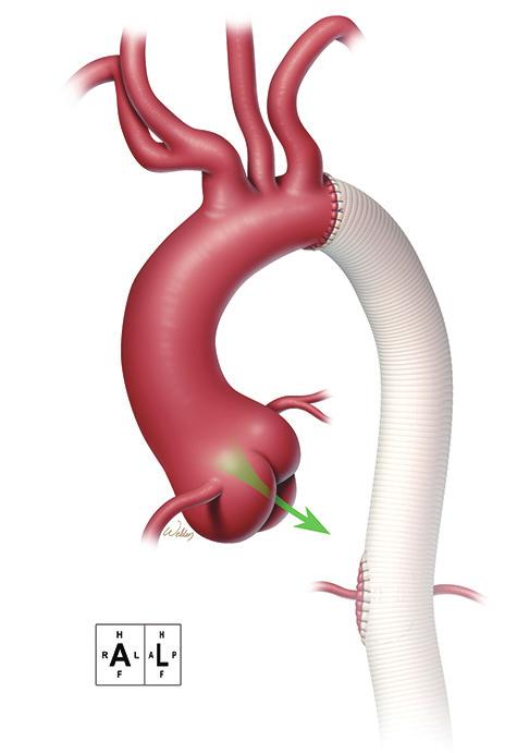 ) diseased aortic root tissue (including the sinuses of Valsalva) was excised, and the coronary arteries were mobilized on buttons of aortic tissue.