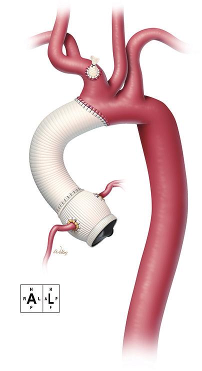 A valve-replacing approach to aortic root replacement was used, and the coronary arteries were reattached as buttons.