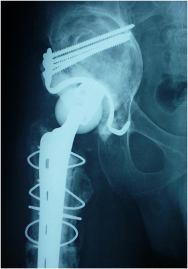 Kanda et al. Journal of Medical Case Reports 2015, 9:17 Page 4 of 5 hemiarthroplasty for the treatment of hip joint pain and erosion of the acetabular roof.