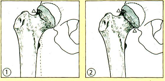 FRACTURE CLASSIFICATION All patients included had a displaced femoral neck fracture (Garden III and IV). 2 The Garden classification is shown in Figures 1 and 2.