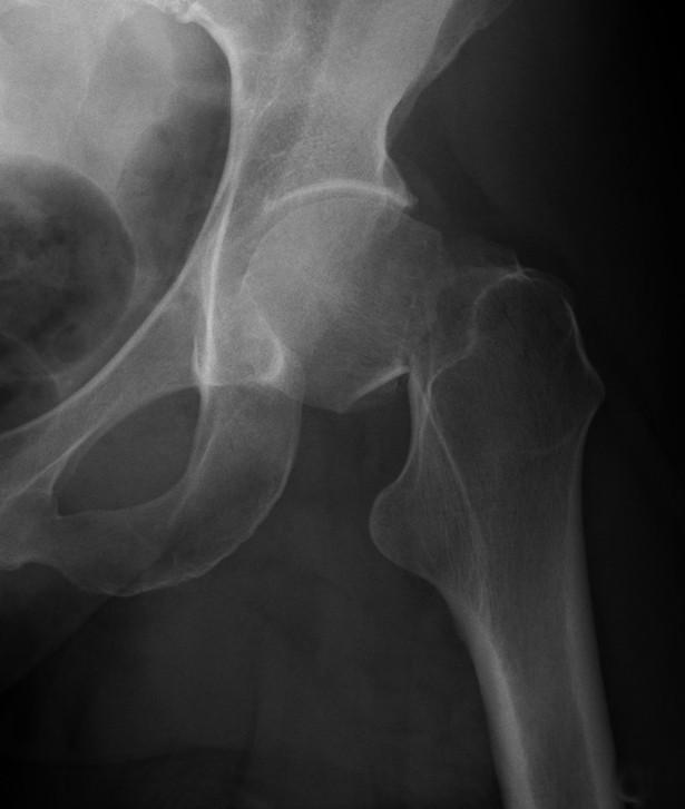 Displaced femoral neck fracture, treated with internal fixation (cannulated screws) Internal fixation (Studies I and IV) was carried out with the patient on a fracture table.