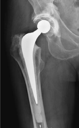 angle being less than 10 ). In the lateral projection, the screws were to be parallel and positioned in the central or posterior third of the femoral head and neck.