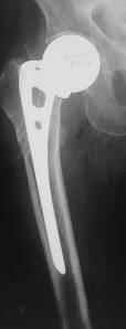 Non-union was defined as an absence of radiographically visible trabeculations across the fracture line, including early redisplacement or progressive displacement.