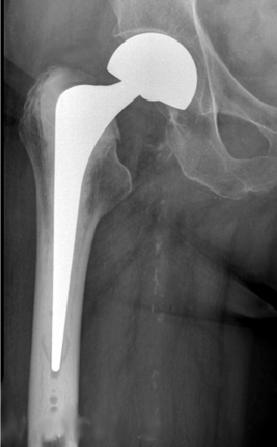 HIP REPLACEMENT Hip replacement was carried out using an anterolateral approach, a modified Hardinge approach, 39 with the patient in the lateral decubitus position. Figure 4. Figure 5. Figure 6.