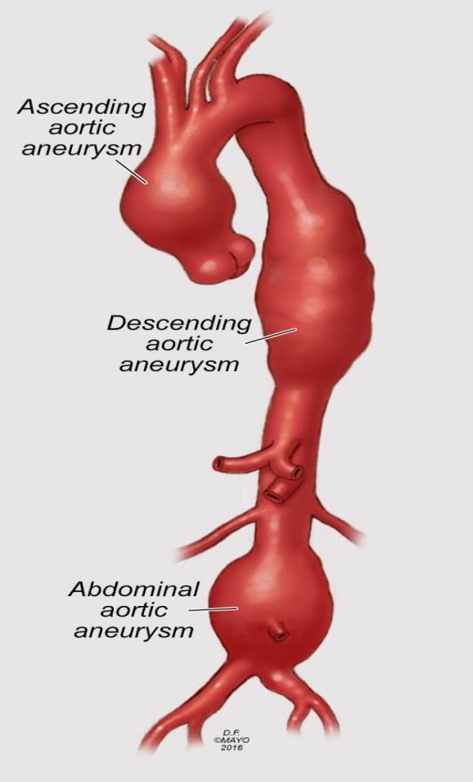 Background Aortic aneurysm - Primary cause of 9,863 deaths in 2014 - Ruptured aneurysm has a high mortality rate