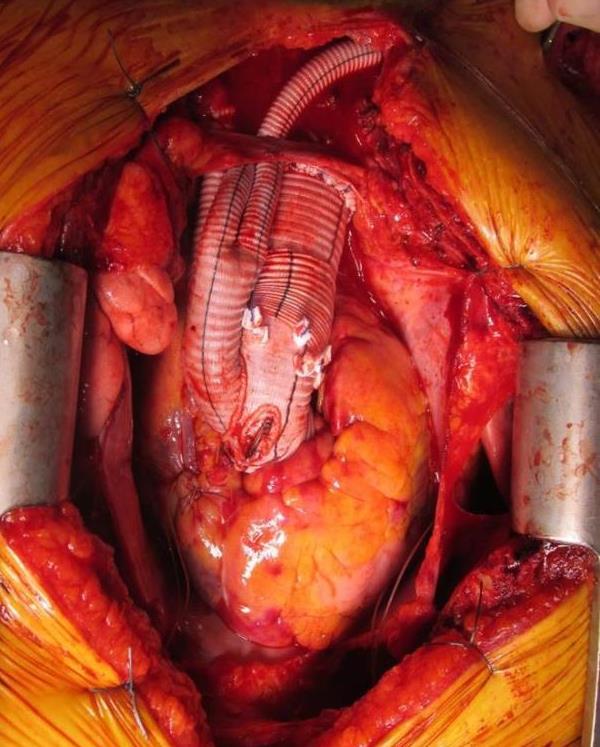 Background Hybrid surgical repair of aortic
