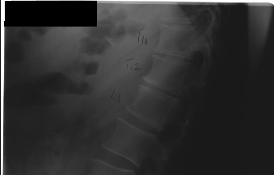 METHODS Lateral lumbar spinal X-ray images were obtained at the Clinical Hospital of the Faculty of Medicine, University of São Paulo, at Ribeirão Preto, SP, Brazil.