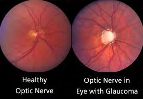 Glaucoma Glaucoma is the name given to a group of eye conditions in which the optic nerve at the back of the eye is slowly damaged.