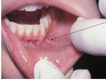 Extending toward the crest of the residual ridge from the buccal