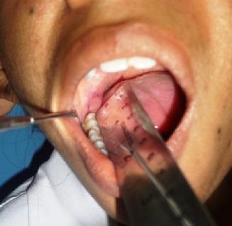 ISSN no:2394-417x Madhav et al,(2015) over the cusps of the mandibular posterior teeth ensuring its contact with the tip of the cuspid on one side of the mandibular arch to make contact with the
