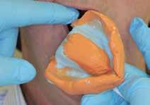 mold the retro-molar area.