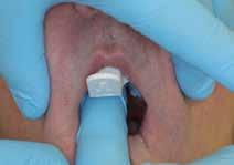 distal buccal periphery and remove.