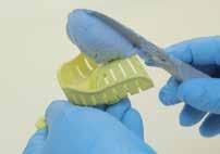 Partial and Dentate Maxillary Impression Tray Loading Load the