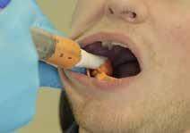 Mandibular Procedure Wipe dry the mandibular buccal and
