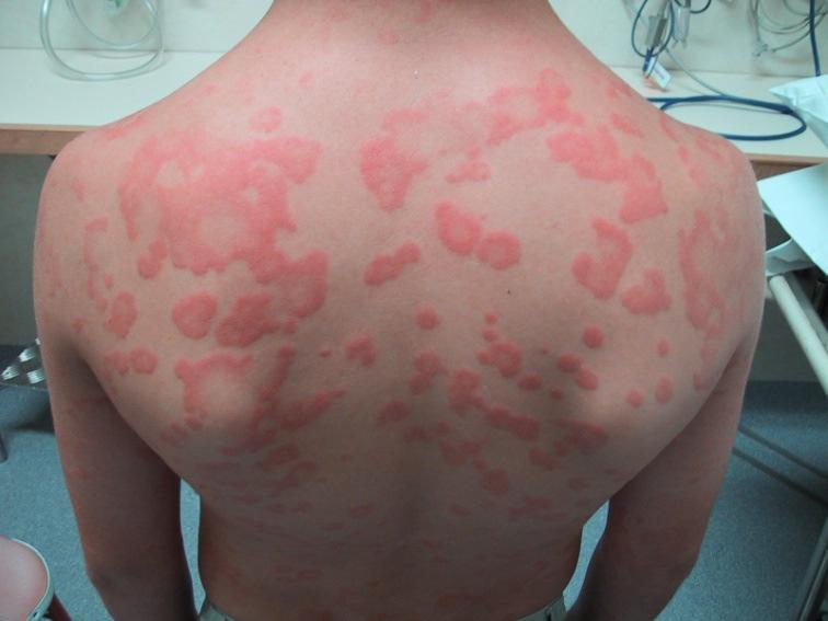 Cutaneous symptoms Urticaria, erythema and angioedema may be transient, subtle and easily overlooked In 1