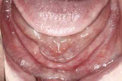 LABIAL AND BUCCAL