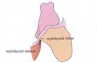 Mylohyoid ridge area A denture border short of the mylohyoid ridges digs into the