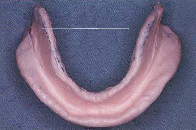 Retromylohyoid fossa It is space distal to mylohyoid muscle.