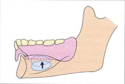 If the denture border made short to relieve the raised sublingual gland, a space will occur between the