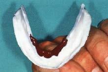 Anterior lingual flange area The border of the