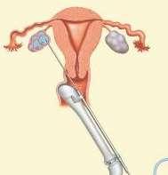 Ovarian tissue